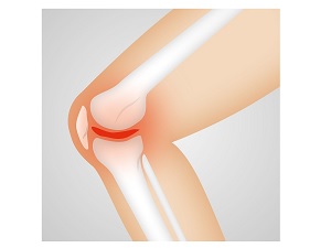 Should You Exercise Through Knee Pain?